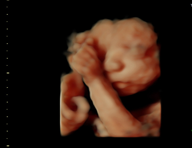 3D ultrasound image at 25 weeks